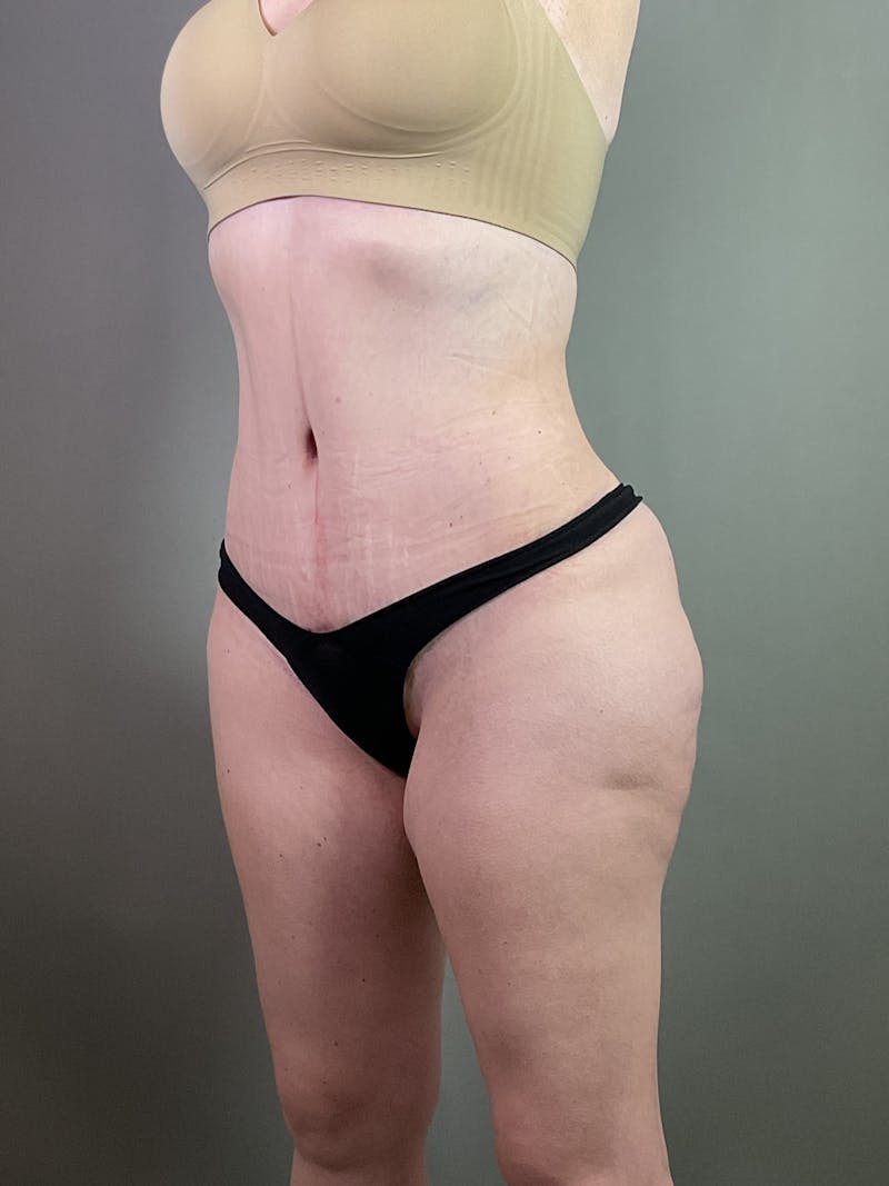 Standard Abdominoplasty Before & After Gallery - Patient 358069 - Image 4