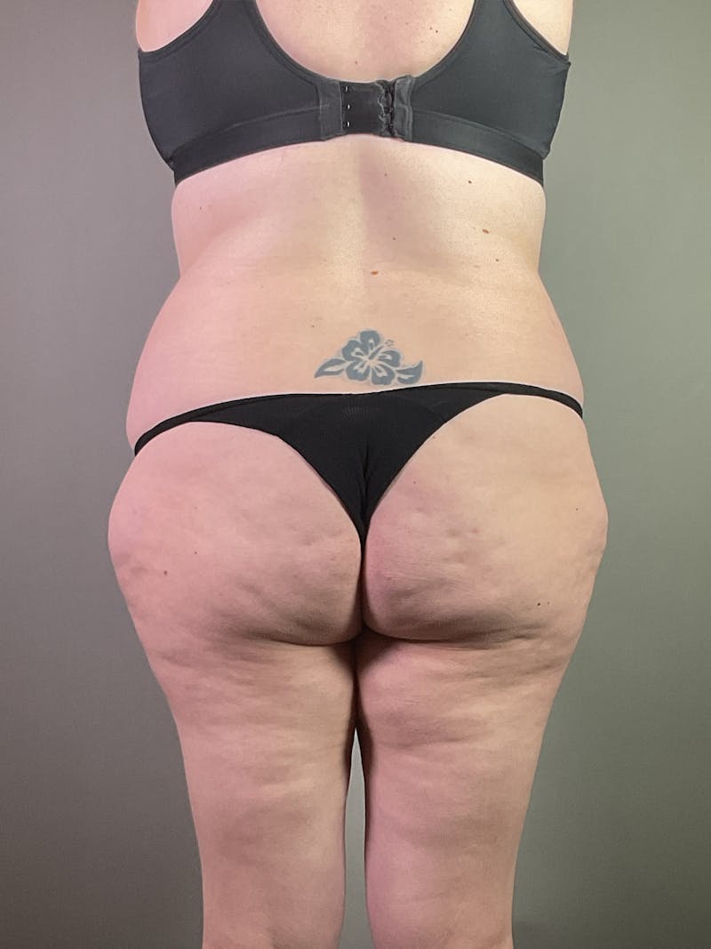 Standard Abdominoplasty Before & After Gallery - Patient 358069 - Image 5