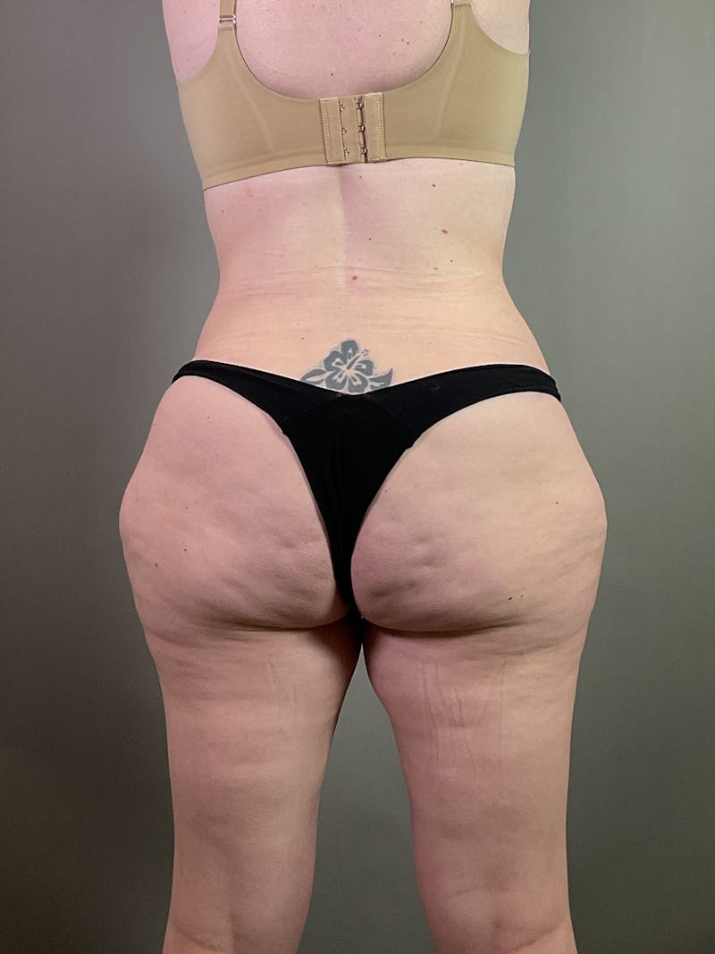 Standard Abdominoplasty Before & After Gallery - Patient 358069 - Image 6