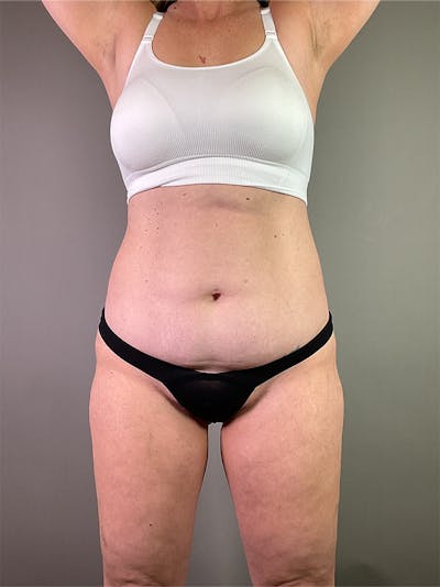Standard Abdominoplasty Before & After Gallery - Patient 600508 - Image 1
