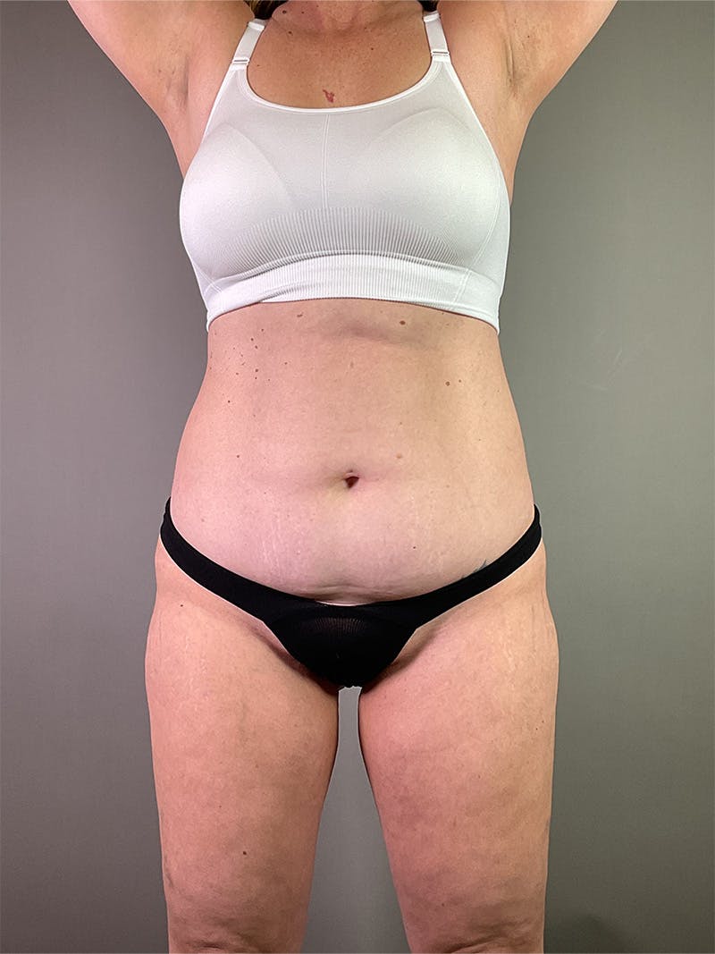 Standard Abdominoplasty Before & After Gallery - Patient 600508 - Image 1