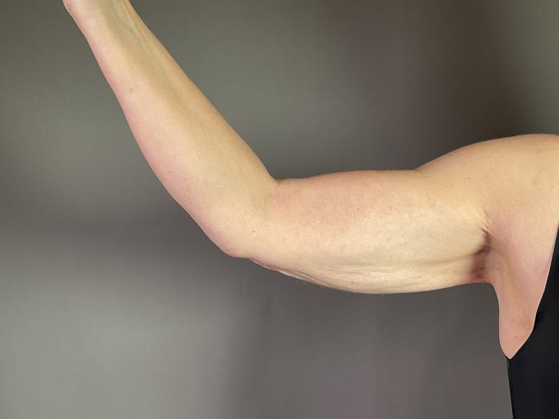 Arm Lift (Brachioplasty) Before & After Gallery - Patient 660042 - Image 4