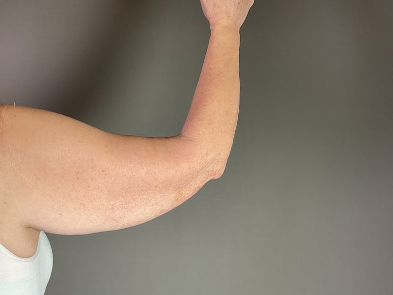 Arm Lift (Brachioplasty) Before & After Gallery - Patient 660042 - Image 1