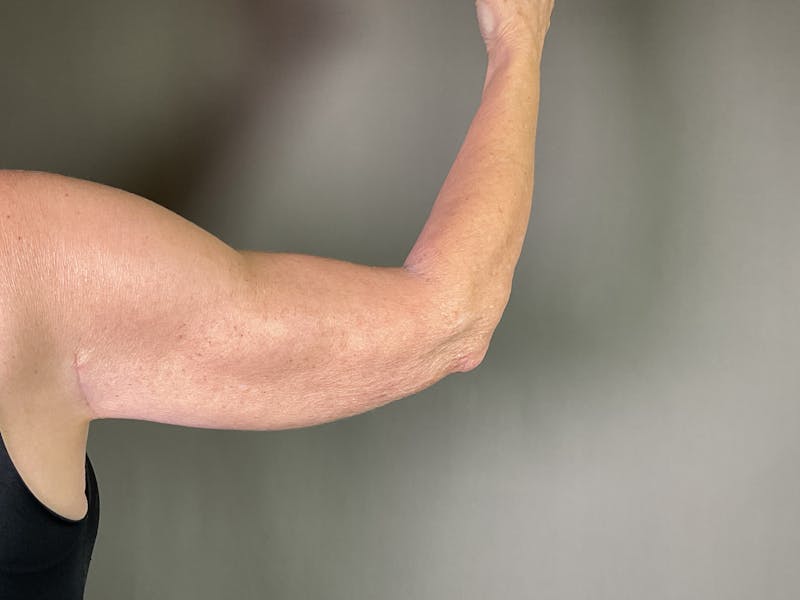 Arm Lift (Brachioplasty) Before & After Gallery - Patient 660042 - Image 2