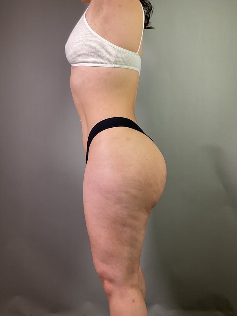 Brazilian Butt Lift Before & After Gallery - Patient 150654 - Image 4
