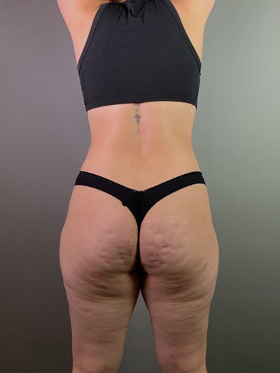 Brazilian Butt Lift Before & After Gallery - Patient 150654 - Image 1