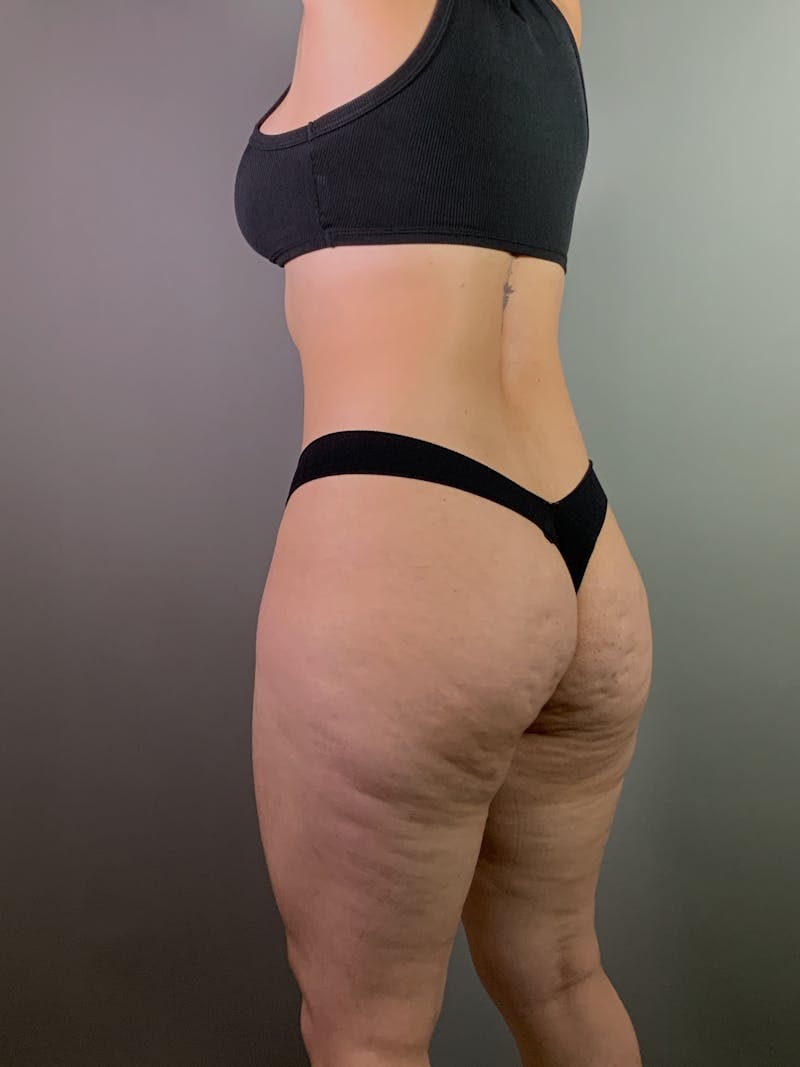 Brazilian Butt Lift Before & After Gallery - Patient 150654 - Image 5