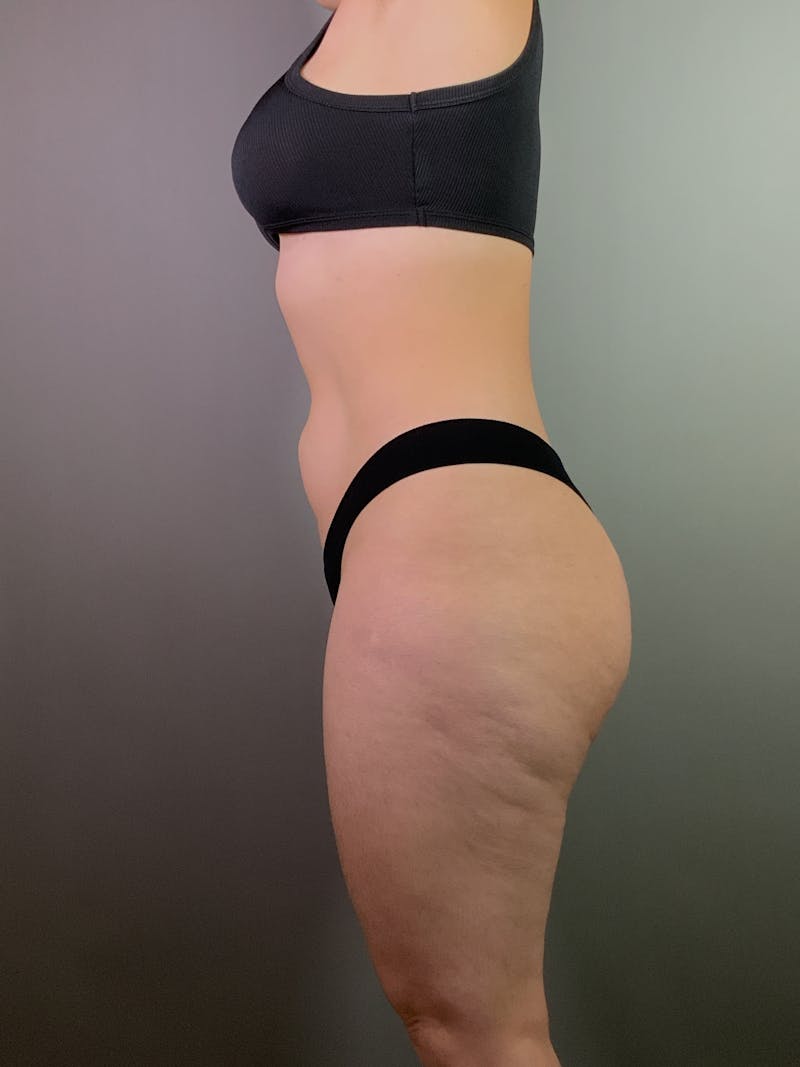 Brazilian Butt Lift Before & After Gallery - Patient 150654 - Image 3