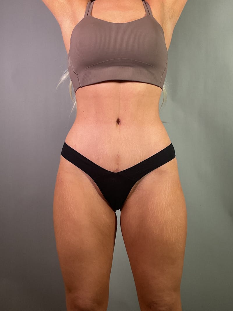 Liposuction Before & After Gallery - Patient 191359 - Image 2