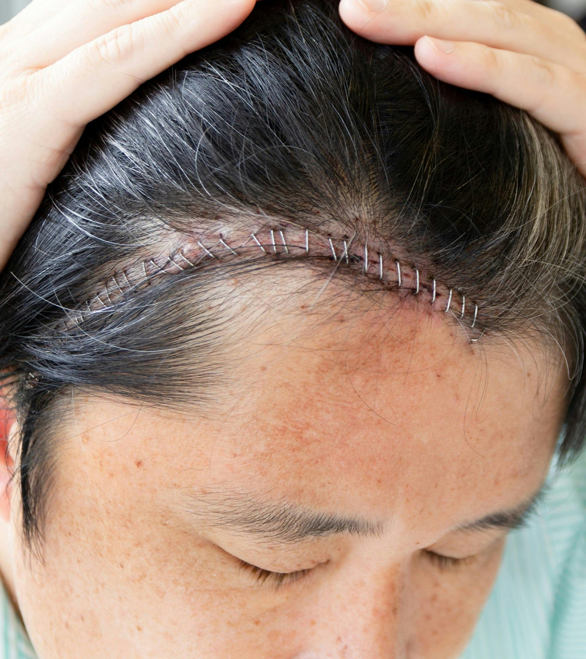 Closeup of stitches on a woman's forehead.