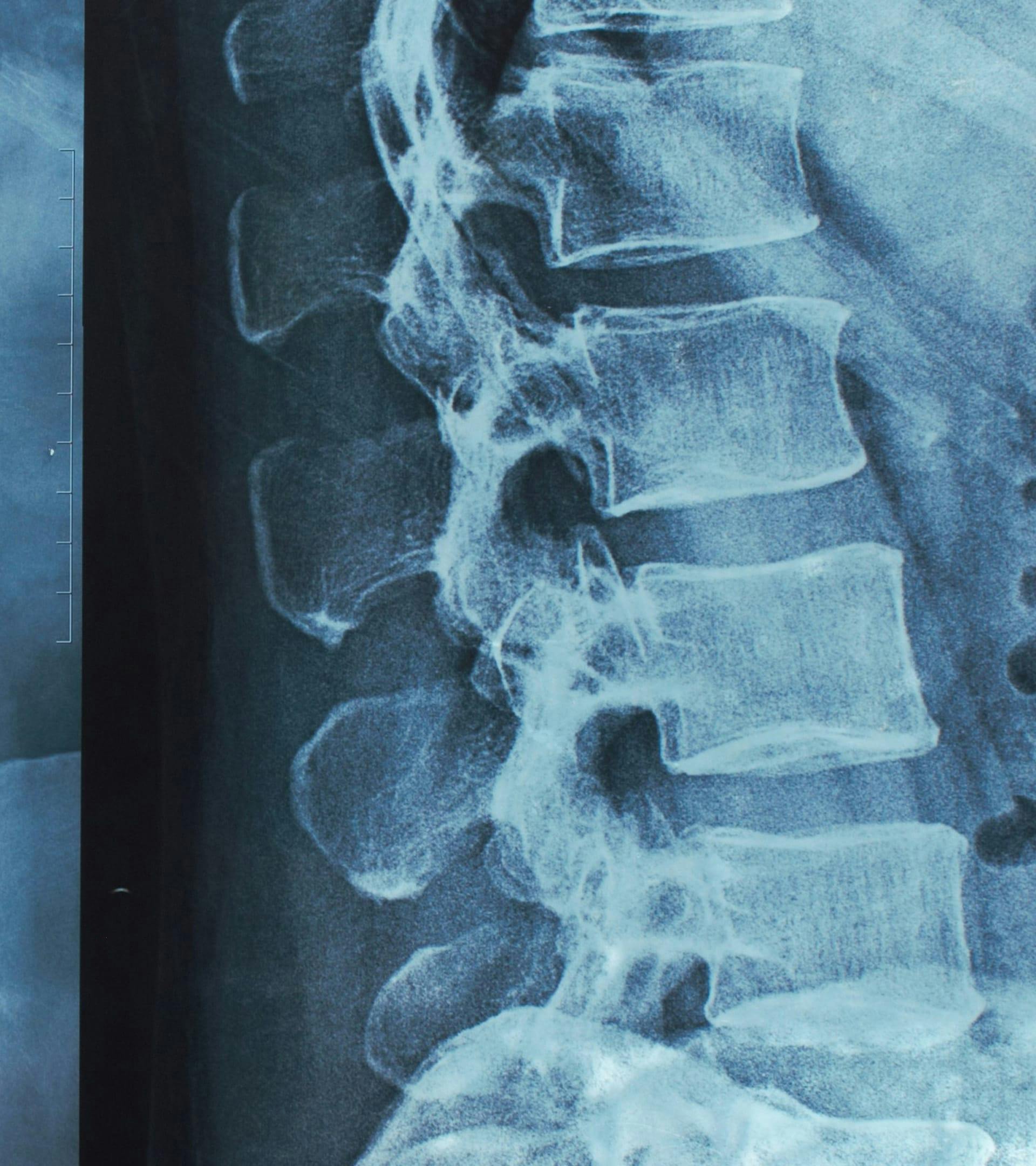 An x-ray of a spine