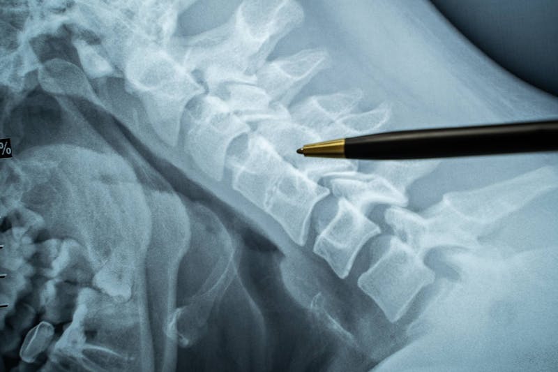 Closeup of an x-ray with someone pointing at it with a pen.