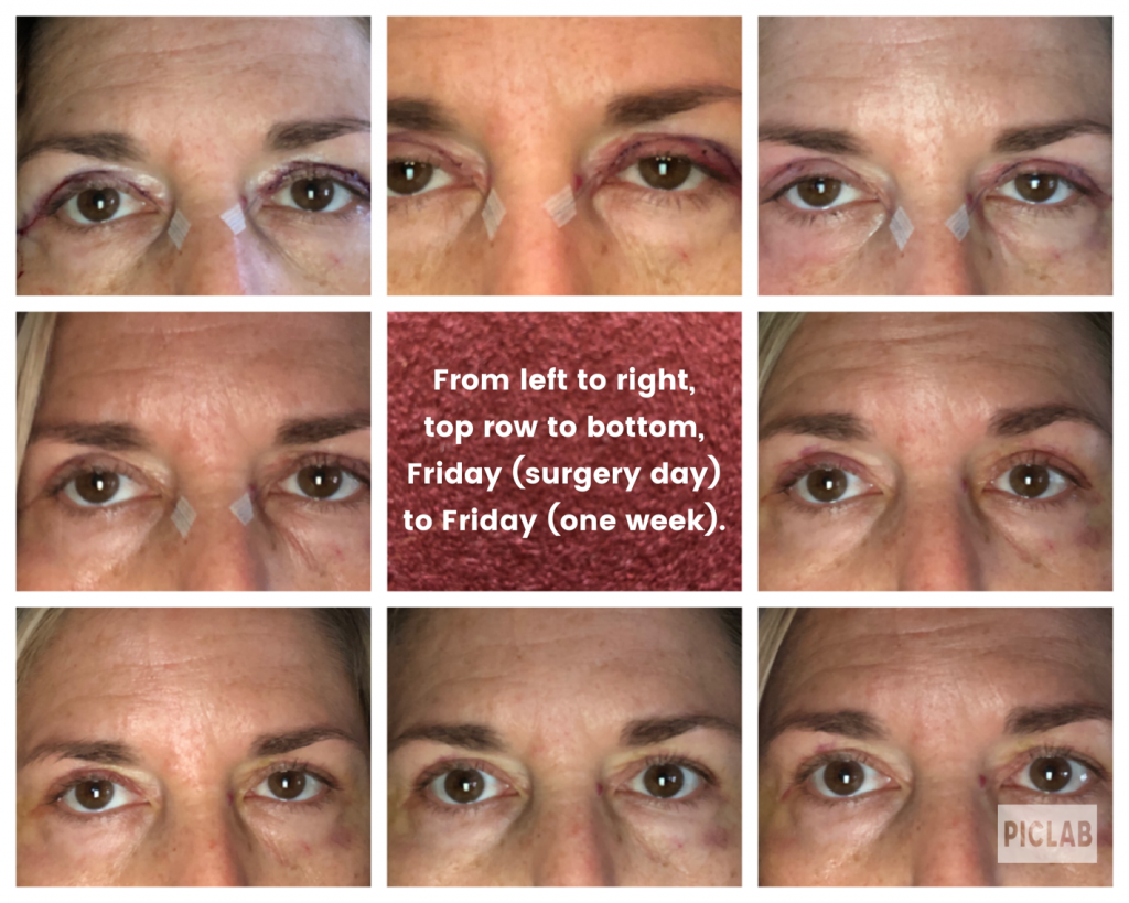 Patient's healing journey after blepharoplasty