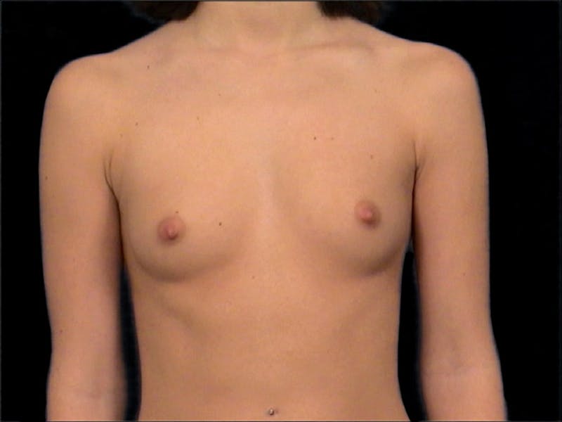 Breast Augmentation Before & After Gallery - Patient 167353829 - Image 1
