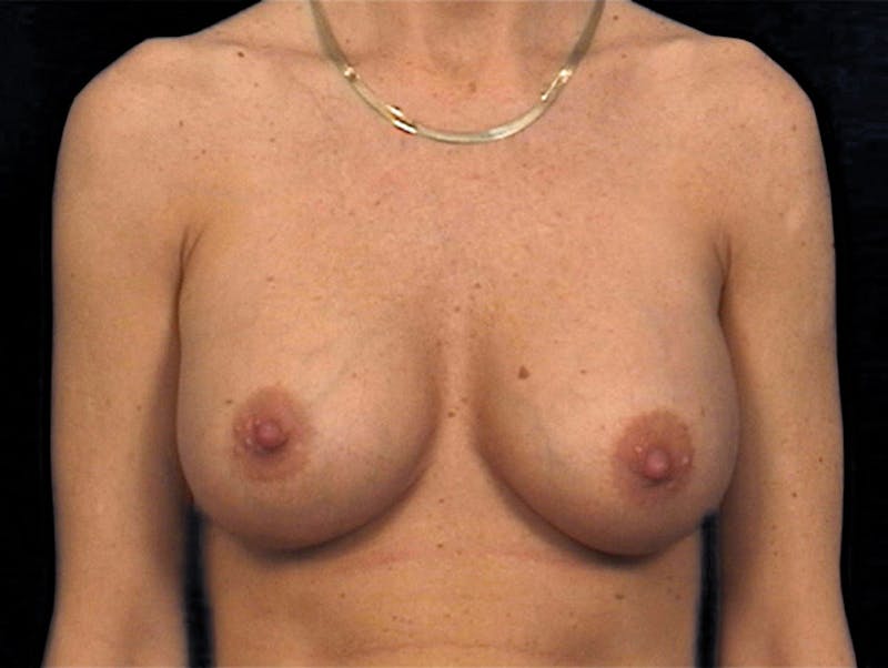 Breast Augmentation Before & After Gallery - Patient 167353850 - Image 2