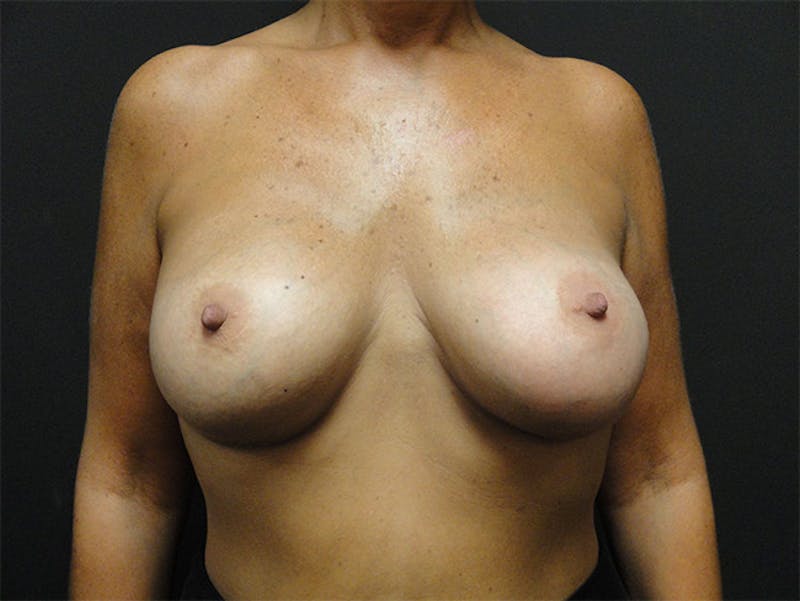 Breast Augmentation Before & After Gallery - Patient 167353858 - Image 2