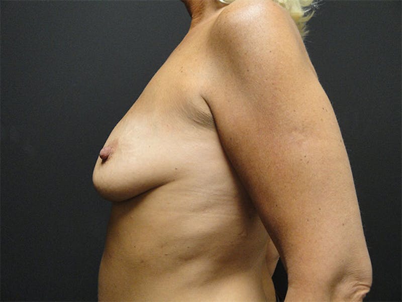 Breast Augmentation Before & After Gallery - Patient 167353858 - Image 3