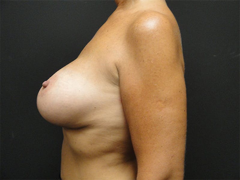 Breast Augmentation Before & After Gallery - Patient 167353858 - Image 6
