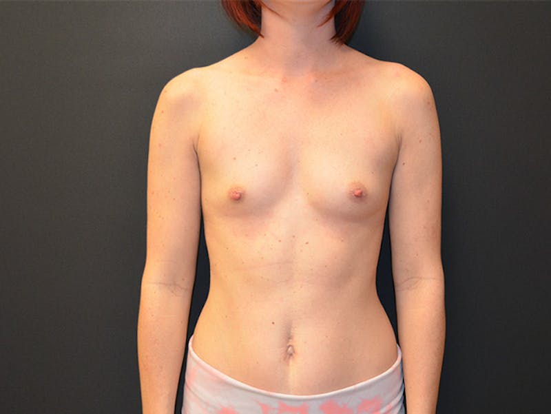 Breast Augmentation Before & After Gallery - Patient 167353882 - Image 1