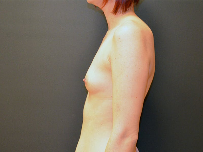 Breast Augmentation Before & After Gallery - Patient 167353882 - Image 5