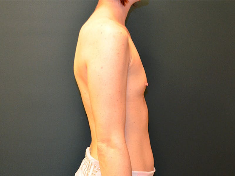 Breast Augmentation Before & After Gallery - Patient 167353882 - Image 9