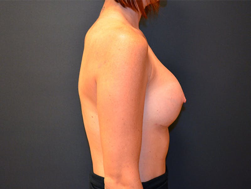 Breast Augmentation Before & After Gallery - Patient 167353882 - Image 10