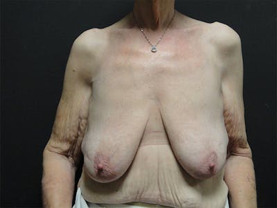 Breast Lift Before & After Gallery - Patient 167353907 - Image 1