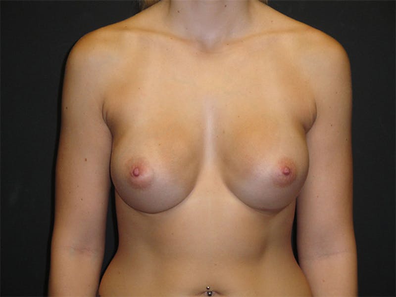 Breast Augmentation Before & After Gallery - Patient 167353935 - Image 2