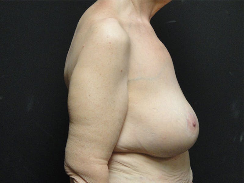Breast Lift Before & After Gallery - Patient 167353907 - Image 4