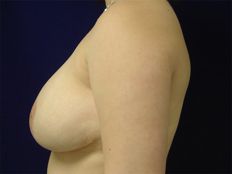 Breast Reduction Before & After Gallery - Patient 167353916 - Image 4