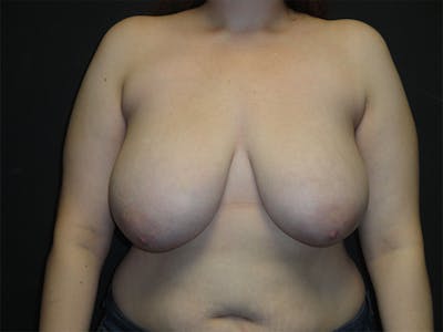 Breast Reduction Before & After Gallery - Patient 167355536 - Image 1