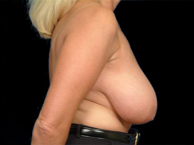 Breast Lift Before & After Gallery - Patient 167353936 - Image 3