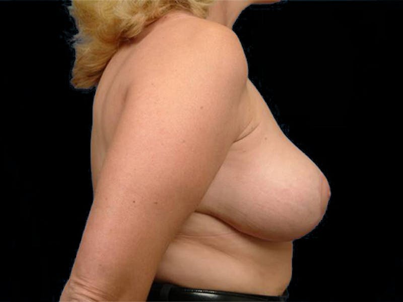 Breast Lift Before & After Gallery - Patient 167353936 - Image 4