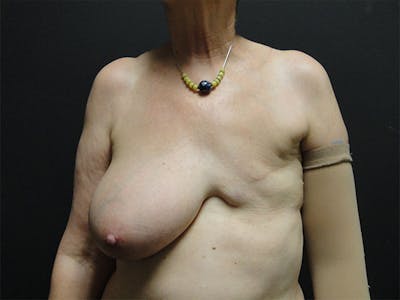 Breast Flap Reconstruction Before & After Gallery - Patient 167355556 - Image 1