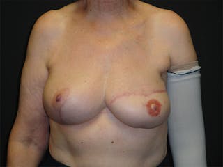 Breast Flap Reconstruction Before & After Gallery - Patient 167355556 - Image 2