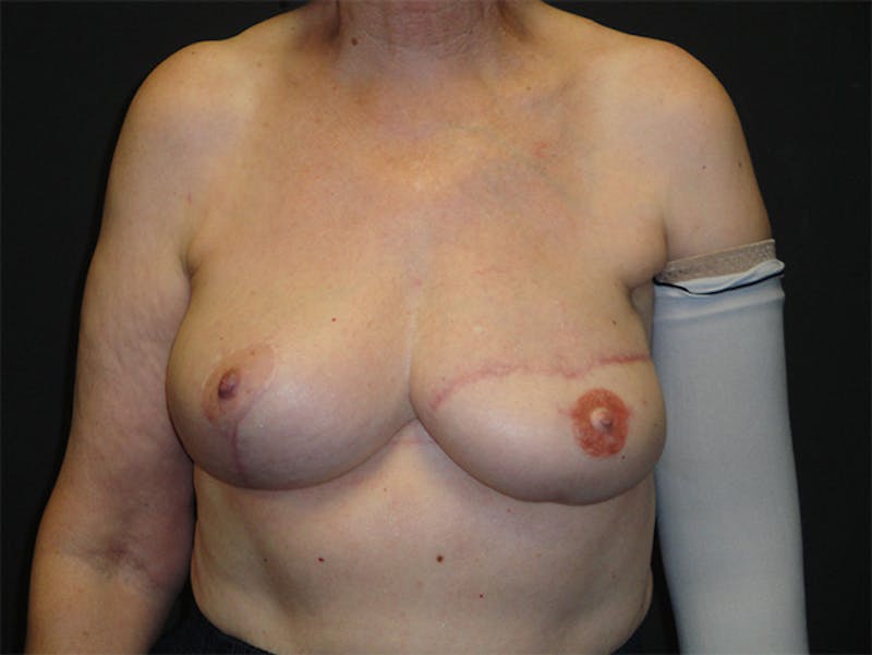 Breast Flap Reconstruction Before & After Gallery - Patient 167355556 - Image 2