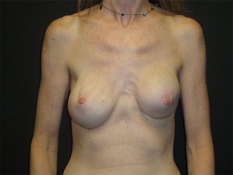 Breast Revision Before & After Gallery - Patient 167355559 - Image 1