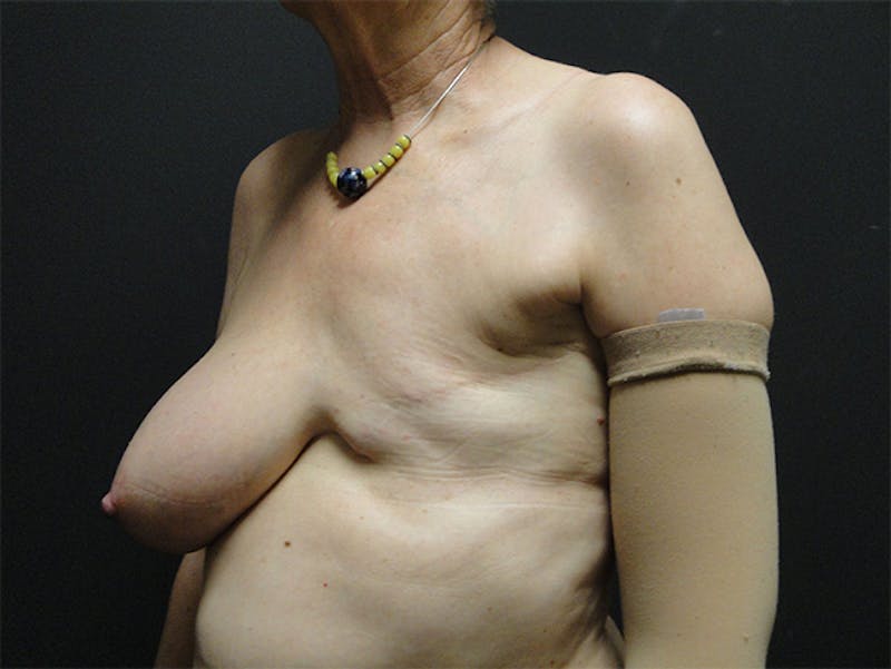 Breast Flap Reconstruction Before & After Gallery - Patient 167355556 - Image 3