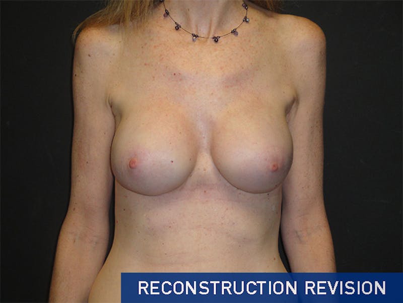 Breast Revision Before & After Gallery - Patient 167355559 - Image 2