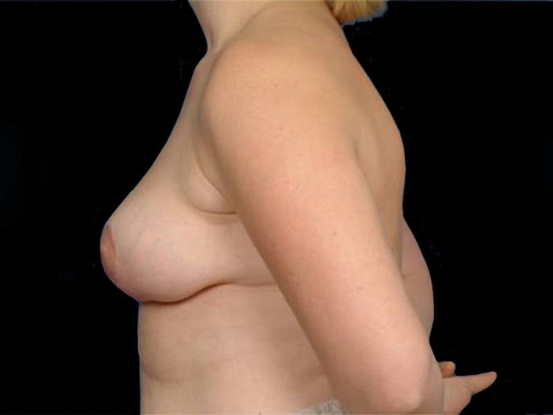 Breast Lift Before & After Gallery - Patient 167355553 - Image 4