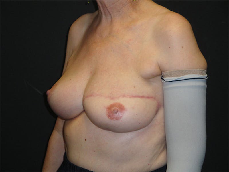 Breast Flap Reconstruction Before & After Gallery - Patient 167355556 - Image 4