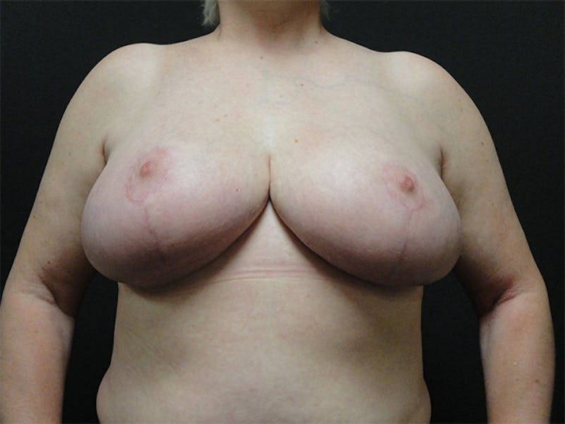 Breast Reduction Before & After Gallery - Patient 167355557 - Image 2