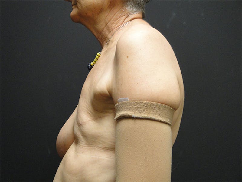 Breast Flap Reconstruction Before & After Gallery - Patient 167355556 - Image 5