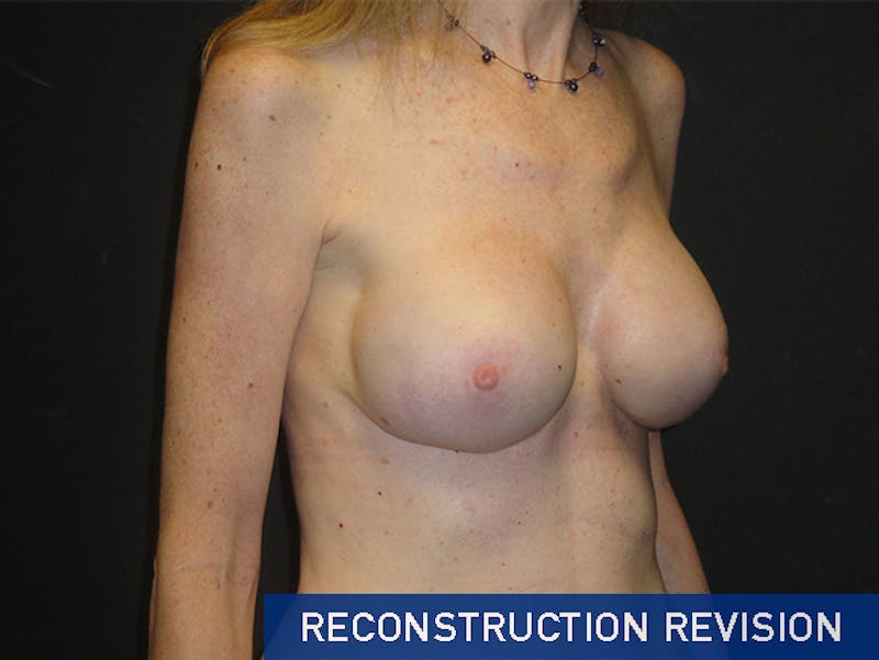 Breast Revision Before & After Gallery - Patient 167355559 - Image 4