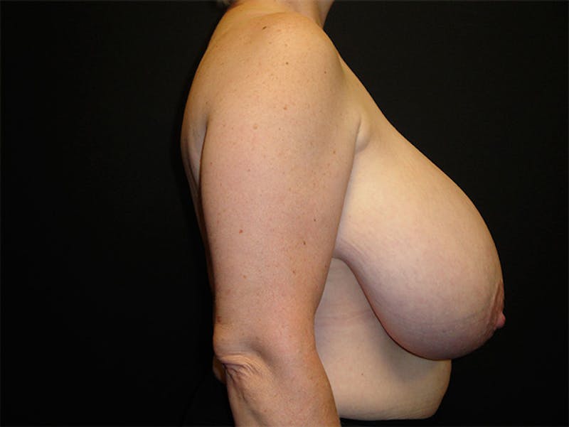 Breast Reduction Before & After Gallery - Patient 167355557 - Image 3