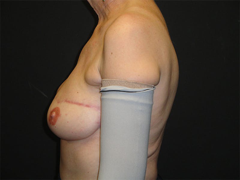 Breast Flap Reconstruction Before & After Gallery - Patient 167355556 - Image 6