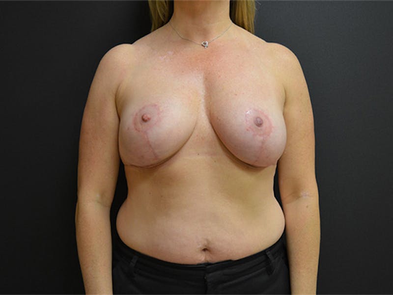 Breast Lift Before & After Gallery - Patient 167355571 - Image 2