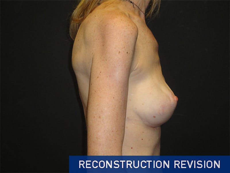 Breast Revision Before & After Gallery - Patient 167355559 - Image 6