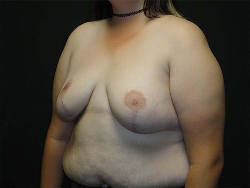 Breast Asymmetry Correction Before & After Gallery - Patient 167355560 - Image 4