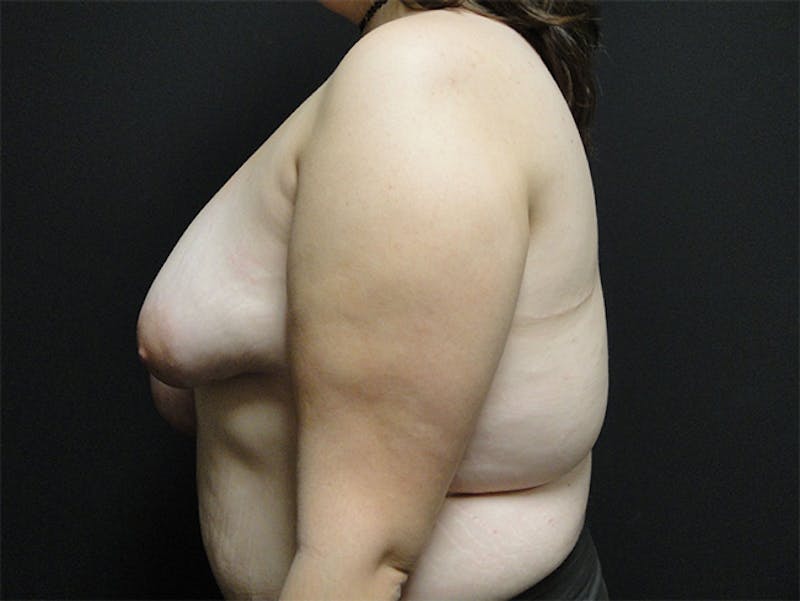 Breast Asymmetry Correction Before & After Gallery - Patient 167355560 - Image 5